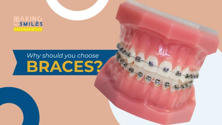 Why Should You Choose Braces?